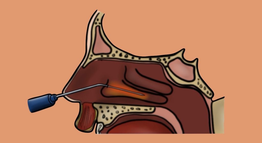 cirugía de cornetes
