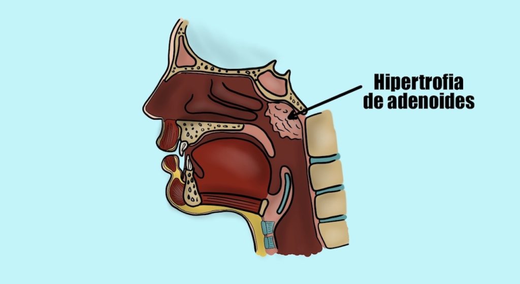 hipertrofia de adenoides